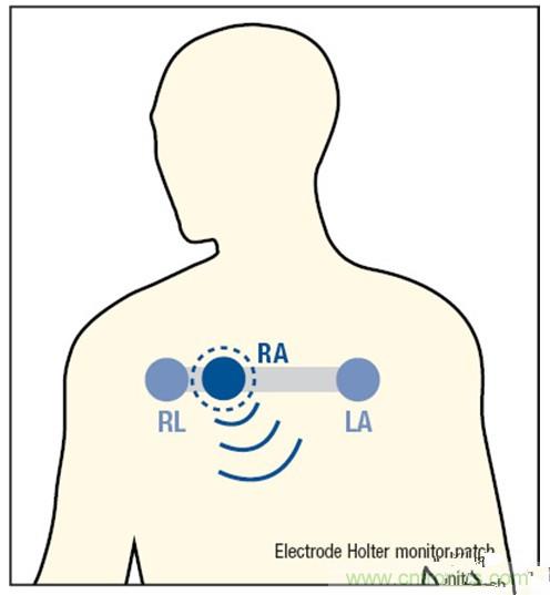 解析:一款可穿戴無(wú)線ECG動(dòng)態(tài)心電監(jiān)護(hù)儀的設(shè)計(jì)