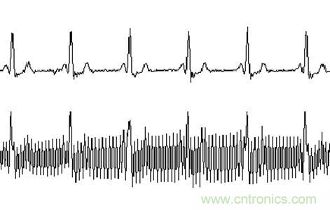 采用MSP430設(shè)計的12位心電(ECG)放大器 采用MSP430設(shè)計的12位心電(ECG)放大器